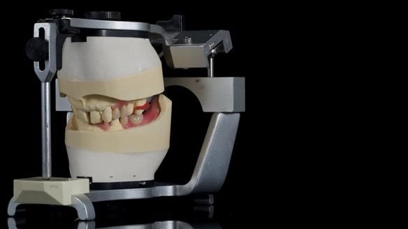 Newsletter 86 Peter the Architect — precision removable partial dentures case study