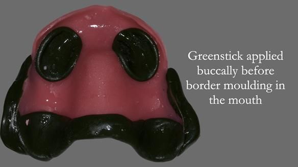 Newsletter 50 Special edition Complete Dentures FULL PROTOCOL