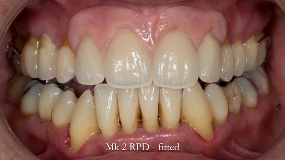 Finlay's Newsletter 63 Case study provision of metal based Scandinavian RPD - functional 10 years on