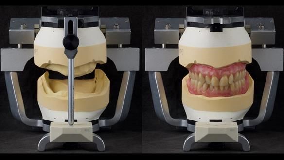 Complete denture Class II div 2 deep overbite Newsletter 39