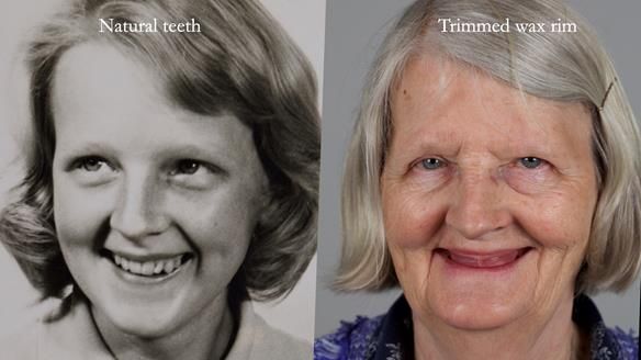Newsletter 82 Mary - A complete upper and a one-tooth gasket denture
