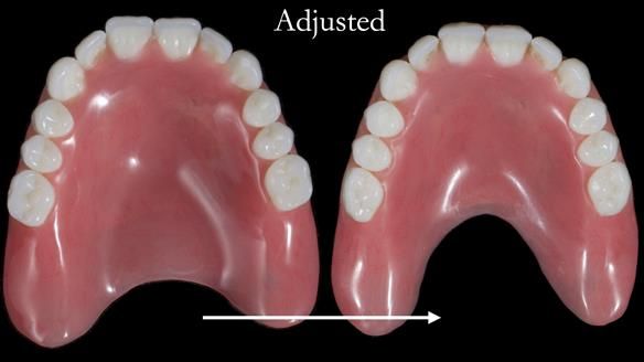Newsletter 65 Marisa Provision of Complete Dentures on badly placed implants