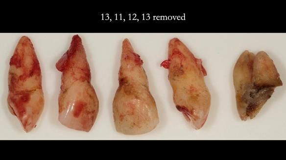 Finlay's Newsletter 63 Case study provision of metal based Scandinavian RPD - functional 10 years on
