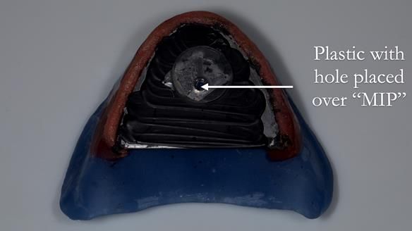 Newsletter 80 - Gordon’s dentures: the one case in 1,000 where my technique failed