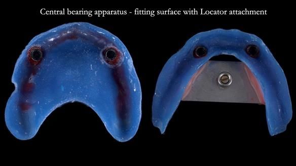 Newsletter 57 showcases the making and fitting process of implant-supported complete dentures for Alisdair