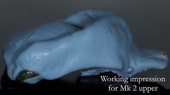 Finlay's Case Study Newsletter 40 - Immediate Mk 1 RPD to Definitive Mk 2 RPD - full protocol