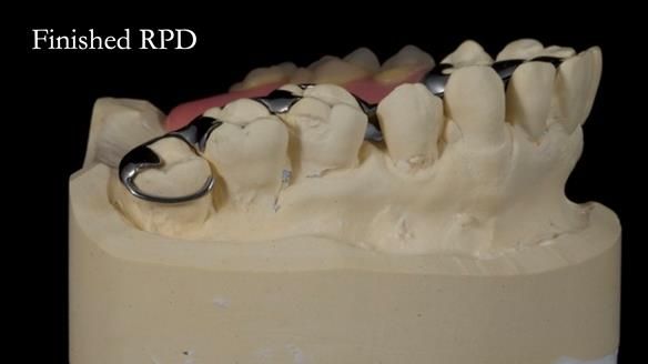 Finlay's Newsletter 64 case study - provision of a Kennedy class 2 metal based Scandinavian RPD for Ian