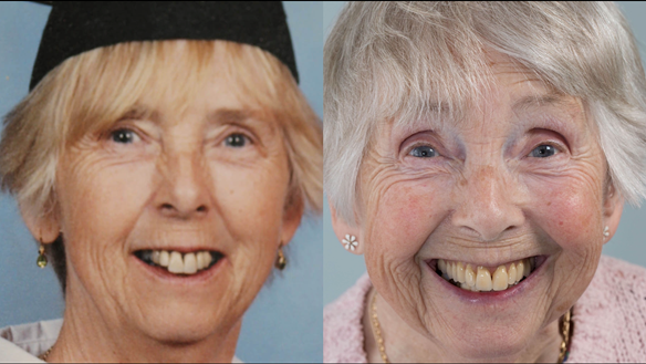 Figure 104 Comparison of natural teeth and Mk 2 complete upper denture