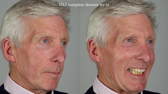 Newsletter 77: Jeremy’s case – immediate complete upper denture