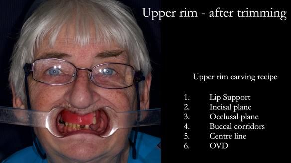 Newsletter 55 Provision of metal based partial dentures for Zephyrine with a repaired cleft lip and palate