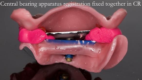 Newsletter 54 case presentation upper complete denture and lower Scandinavian designed hygienic partial denture for David
