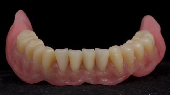 Finlay's Newsletter 62 provision of extractions and metal based complete dentures for Rafique