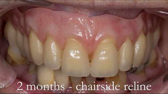 Figure 39 Alveolar resorption has occurred - chairside reline indicated
