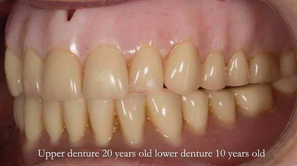 Newsletter 75: Marion’s case - Step-by-step complete denture workflow