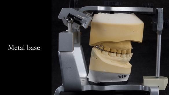 Upper metal base partial denture/occlusal stabilisation splint/obturator - full protocol