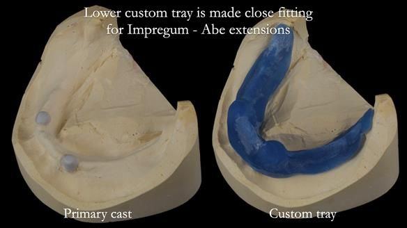Newsletter 57 showcases the making and fitting process of implant-supported complete dentures for Alisdair