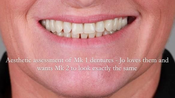 Newsletter 52 Managing Jo’s failing dentition with extractions and Mk 1/Mk 2 complete upper dentures and lower partial dentures FULL PROTOCOL