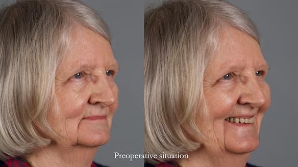 Newsletter 82 Mary - A complete upper and a one-tooth gasket denture