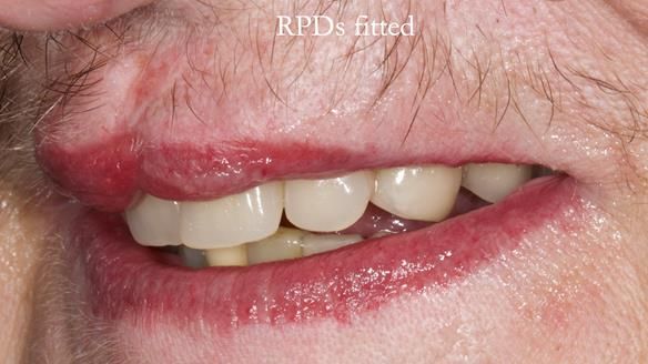 Newsletter 55 Provision of metal based partial dentures for Zephyrine with a repaired cleft lip and palate