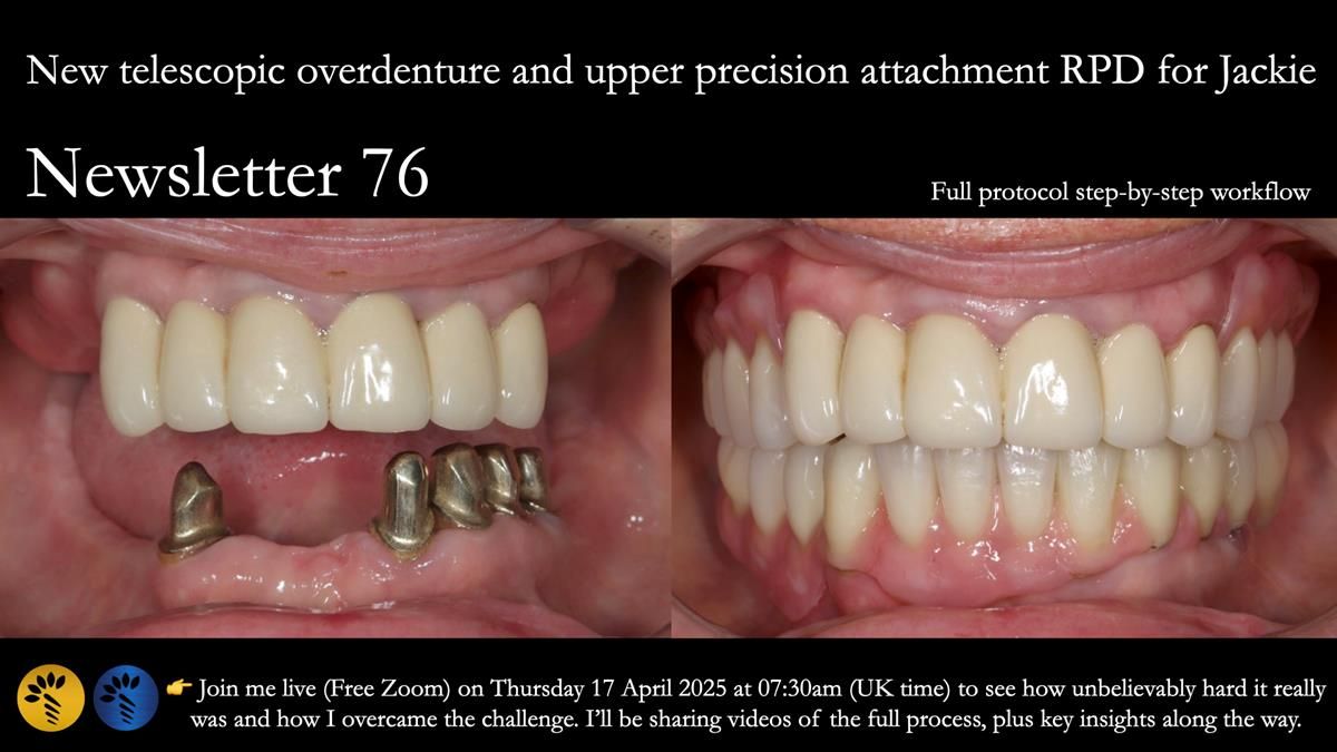 Newsletter 76: Jackie’s case – Telescopic overdenture & precision RPD (the tricky truth!)