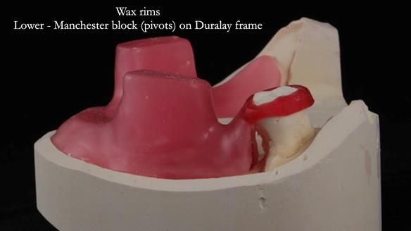 Finlay's Newsletter 59 Ultra hard partial dentures made for Gill