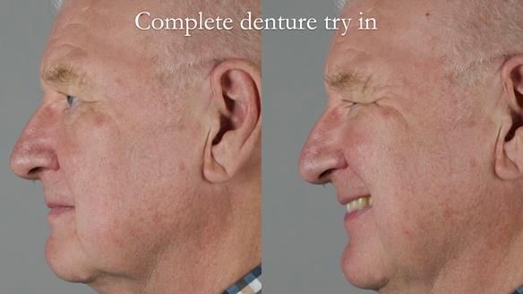 Newsletter 57 showcases the making and fitting process of implant-supported complete dentures for Alisdair