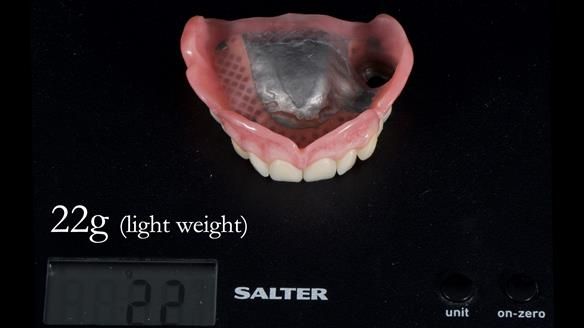 Finlay's Newsletter 59 Ultra hard partial dentures made for Gill