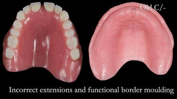 Newsletter 53 showing the making and fitting of ultra life-like dentures for Valena