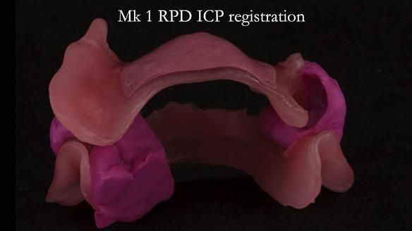 Finlay's Case Study Newsletter 40 - Immediate Mk 1 RPD to Definitive Mk 2 RPD - full protocol