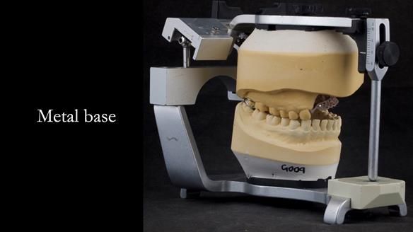 Upper metal base partial denture/occlusal stabilisation splint/obturator - full protocol