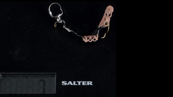 Newsletter 86 Peter the Architect — precision removable partial dentures case study