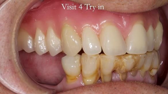 Newsletter 54 case presentation upper complete denture and lower Scandinavian designed hygienic partial denture for David