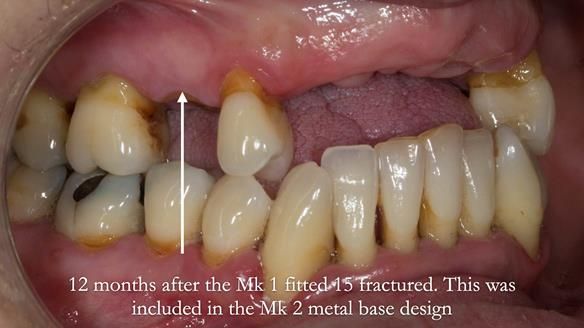 Finlay's Newsletter 63 Case study provision of metal based Scandinavian RPD - functional 10 years on