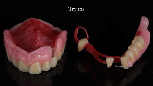 Newsletter 55 Provision of metal based partial dentures for Zephyrine with a repaired cleft lip and palate