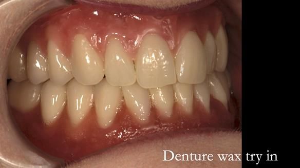 Newsletter 75: Marion’s case - Step-by-step complete denture workflow