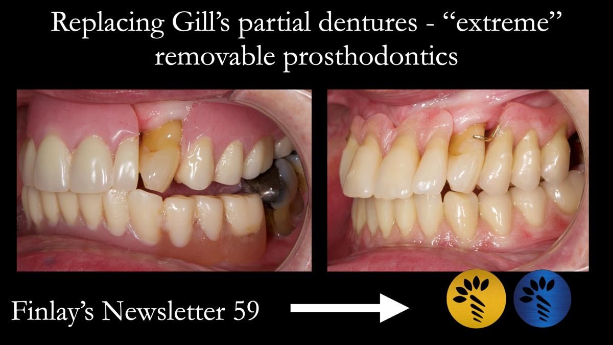 Finlay's Newsletter 59 Ultra hard partial dentures made for Gill