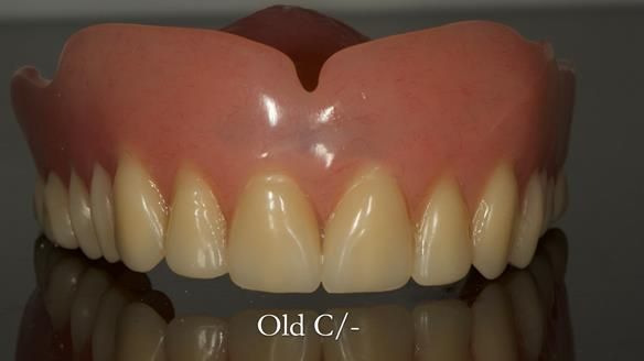 Complete denture Class II div 2 deep overbite Newsletter 39