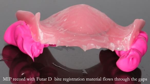 Newsletter 56 showing the making and fitting of a bilateral free end saddle upper removable partial denture (RPD) for patient with pemphigus