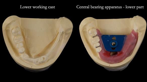 Newsletter 82 Mary - A complete upper and a one-tooth gasket denture