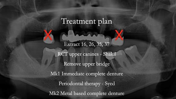 Newsletter 77: Jeremy’s case – immediate complete upper denture