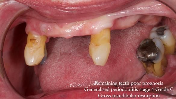 Finlay's Newsletter 59 Ultra hard partial dentures made for Gill