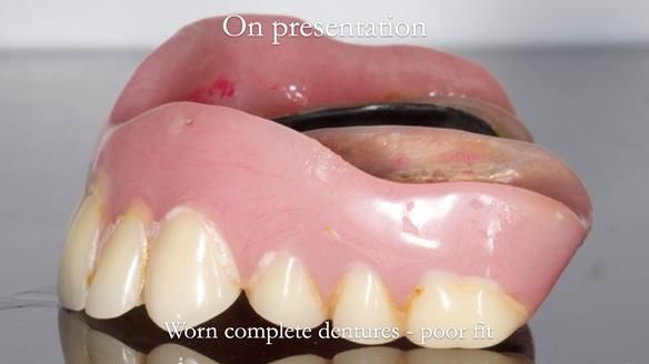Newsletter 57 showcases the making and fitting process of implant-supported complete dentures for Alisdair