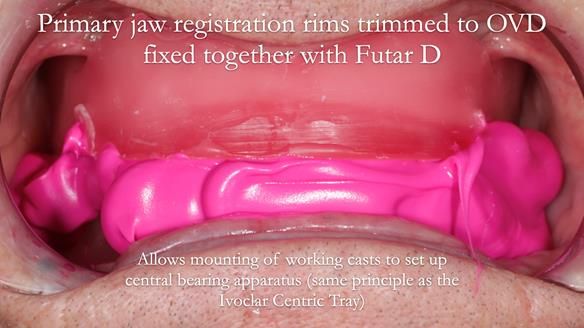 Newsletter 53 showing the making and fitting of ultra life-like dentures for Valena