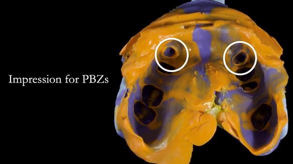 Newsletter 81 - Pam’s Story — how a partial denture changed her life (+ live walkthrough this Thursday)