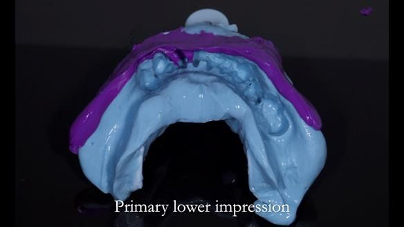 Newsletter 54 case presentation upper complete denture and lower Scandinavian designed hygienic partial denture for David