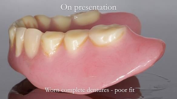 Newsletter 57 showcases the making and fitting process of implant-supported complete dentures for Alisdair