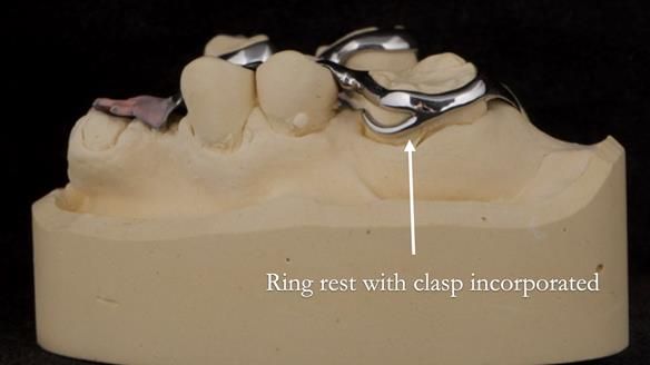 Eileen's transformation with upper and lower RPDs of Scandinavian hygienic design FULL PROTOCOL
