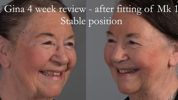 Finlay's Case Study Newsletter 40 - Immediate Mk 1 RPD to Definitive Mk 2 RPD - full protocol