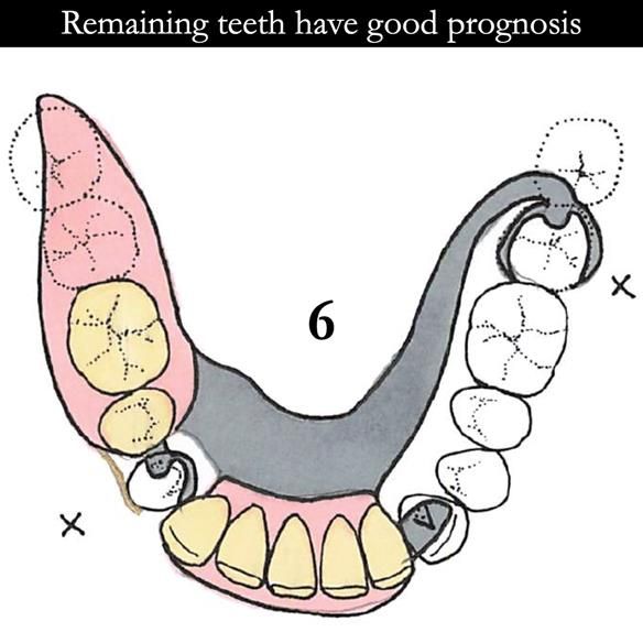 Universal Scandinavian partial denture designs