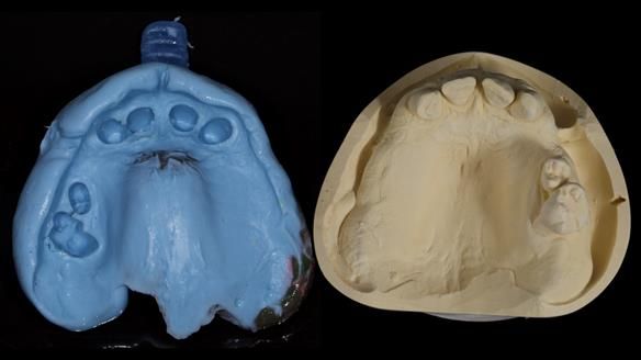 Newsletter 86 Peter the Architect — precision removable partial dentures case study